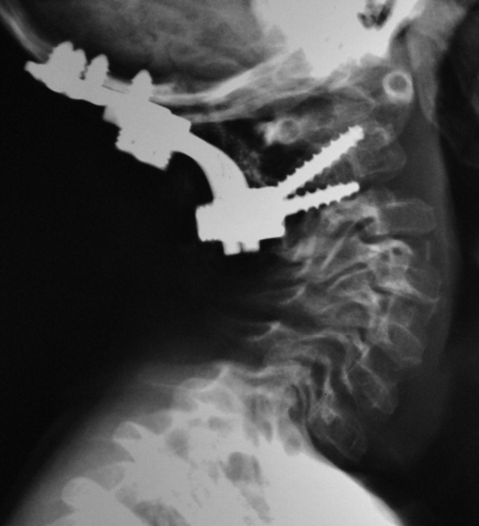 Post-Op